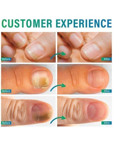 Lápiz Reparador de Uñas elimina Hongos Fungus  !!