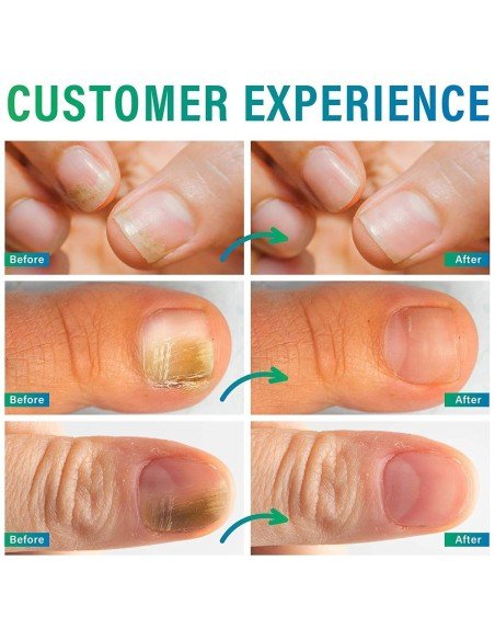 Lápiz Reparador de Uñas elimina Hongos Fungus  !! Lápiz Reparador de Uñas elimina Hongos Fungus  !!